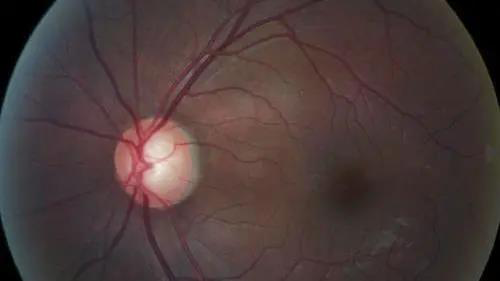 青光眼的克星来袭，，助力患者远离视力的“窃贼”