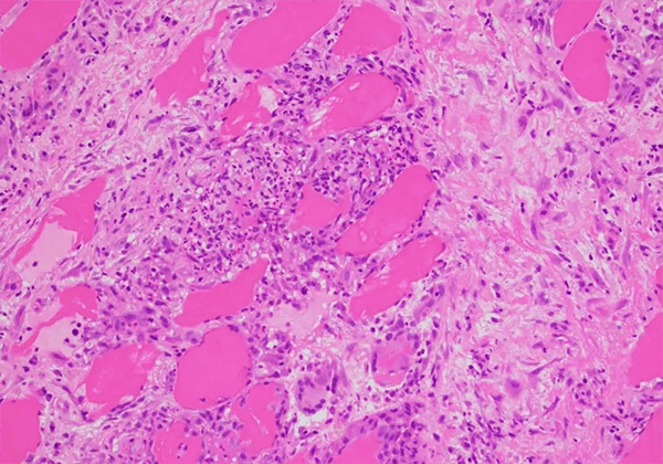 【CC网投助力】治疗结节病的KBMAB-16获FDA批准临床